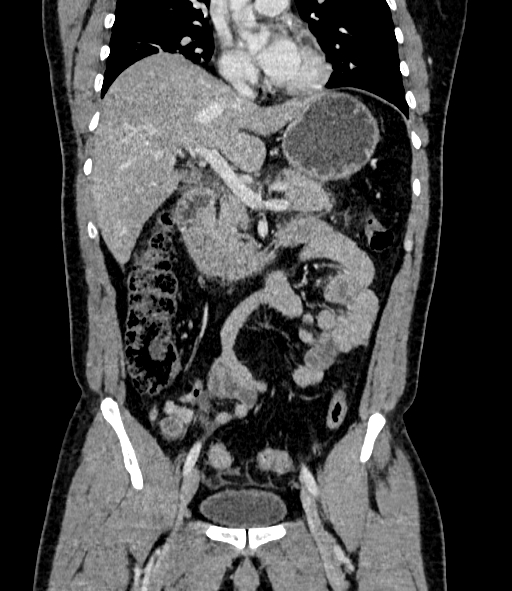 Acute pancreatitis (Radiopaedia 87428-103757 Coronal C+ portal venous phase 42).jpg