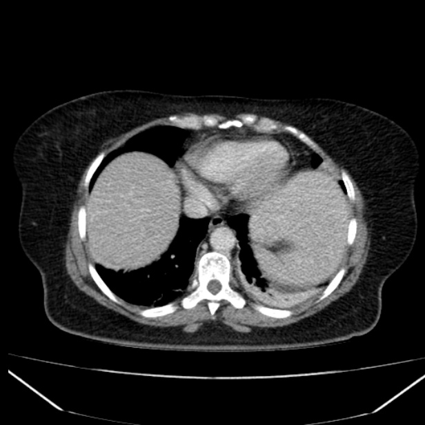 Acute pancreatitis - Balthazar C (Radiopaedia 26569-26714 Axial C+ portal venous phase 18).jpg