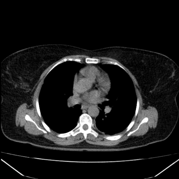 Acute pancreatitis - Balthazar C (Radiopaedia 26569-26714 Axial non-contrast 2).jpg