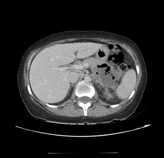 Acute pancreatitis - Balthazar E - post ERCP (Radiopaedia 27562-27772 Axial C+ portal venous phase 24).png