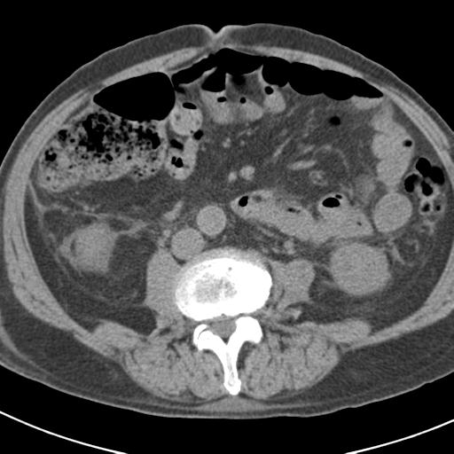 File:Acute pancreatitis and walled-off necrosis (Radiopaedia 29888-30403 Axial non-contrast 40).jpg
