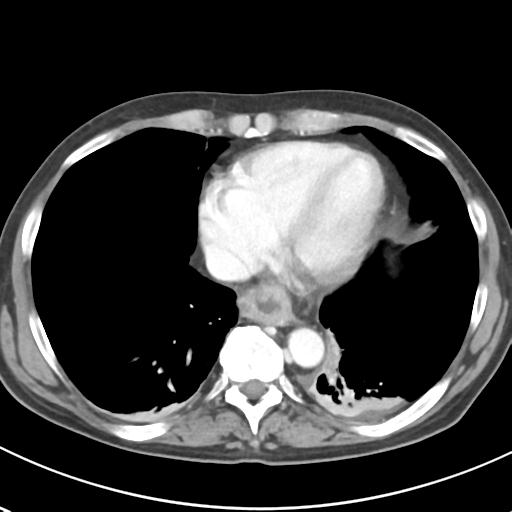 File:Acute pancreatitis and walled-off necrosis (Radiopaedia 29888-30404 Axial C+ portal venous phase 5).jpg