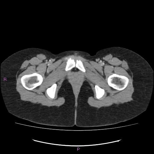 Acute pancreatitis secondary to stone at minor papilla and pancreatic divisum (Radiopaedia 76570-88333 Axial C+ portal venous phase 85).jpg