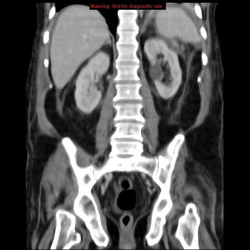 Acute pancreatitis with incidental pancreatic lipoma (Radiopaedia 10190-10730 Coronal C+ portal venous phase 50).jpg