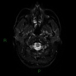 Acute posterior cerebral artery territory infarct (Radiopaedia 79329-92394 Axial DWI 31).jpg