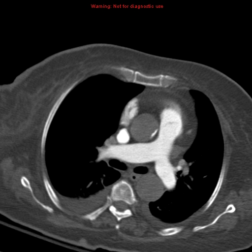 Acute pulmonary embolism (Radiopaedia 13286-13289 Axial C+ CTPA 31).jpg