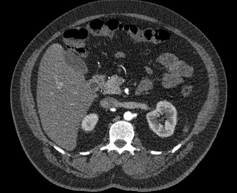 Acute pulmonary embolism with pulmonary infarcts (Radiopaedia 77688-89908 Axial C+ CTPA 87).jpg