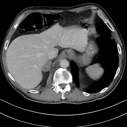 Acute renal infarction - rim capsular enhancement (Radiopaedia 59833-67270 Axial C+ portal venous phase 19).jpg