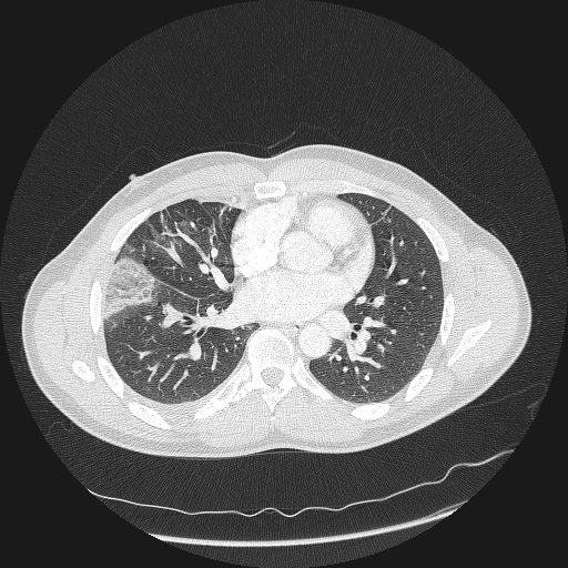 File:Acute segmental pulmonary emboli and pulmonary infarction (Radiopaedia 62264-70444 Axial lung window 106).jpg