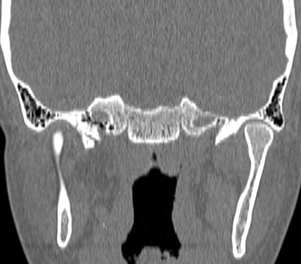Acute sinusitis (Radiopaedia 40564-43158 Coronal bone window 51).jpg
