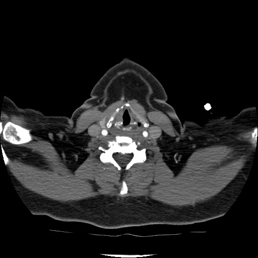 Acute subarachnoid hemorrhage and accessory anterior cerebral artery (Radiopaedia 69231-79009 Axial C+ arterial phase 42).jpg