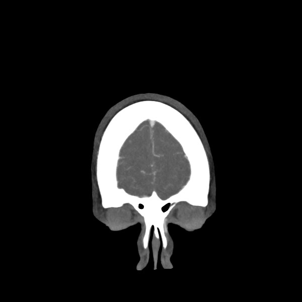 Acute subarachnoid hemorrhage and accessory anterior cerebral artery (Radiopaedia 69231-79009 Coronal C+ arterial phase 10).jpg