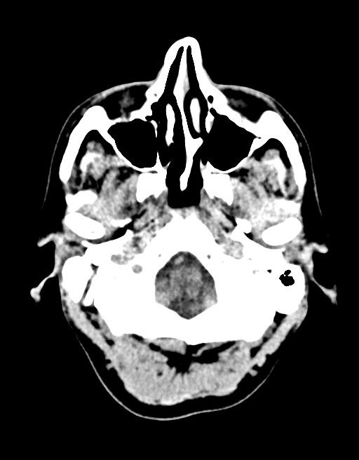 Acute superior cerebellar artery territory infarct (Radiopaedia 84104-99359 Axial non-contrast 59).jpg