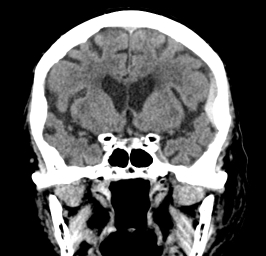File:Acute traumatic subdural hematoma (Radiopaedia 82921-97257 Coronal non-contrast 40).jpg