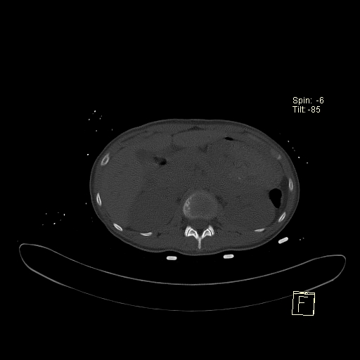 File:Acute vertebral compression fracture (Radiopaedia 63832-72559 Axial bone window 7).jpg