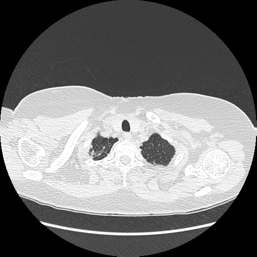 Adenocarcinoma in situ of lung (Radiopaedia 38685-40829 B 19).png