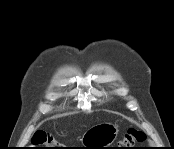 Adenocarcioma of rectum- T1 lesion (Radiopaedia 36921-38547 Coronal C+ arterial phase 10).png