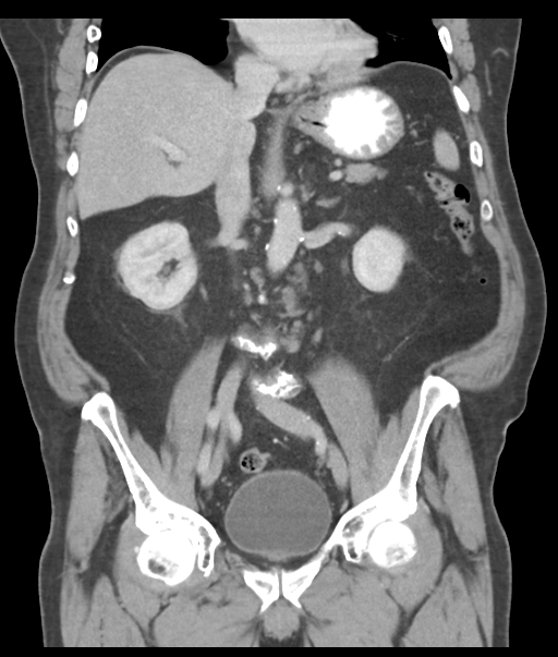 Adenocarcioma of rectum- T1 lesion (Radiopaedia 36921-38547 Coronal C+ portal venous phase 34).png