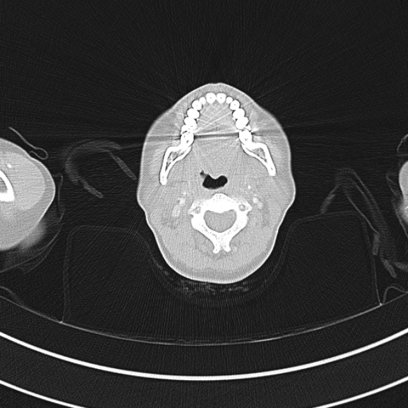 Adenocystic carcinoma of the trachea (Radiopaedia 47677-52525 Axial lung window 11).jpg