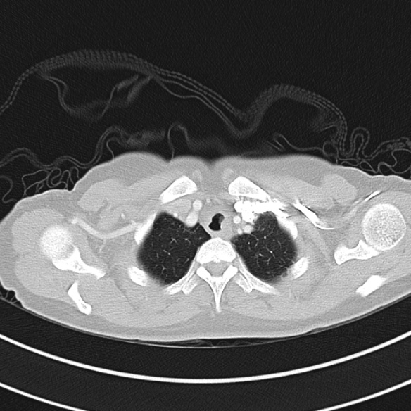File:Adenocystic carcinoma of the trachea (Radiopaedia 47677-52525 Axial lung window 32).jpg