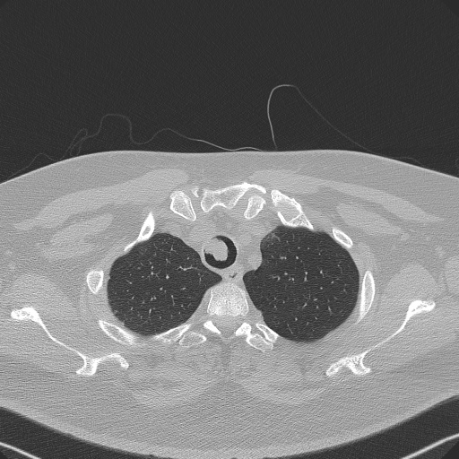 Adenoid cystic carcinoma of the trachea (Radiopaedia 49042-54137 Axial lung window 53).jpg