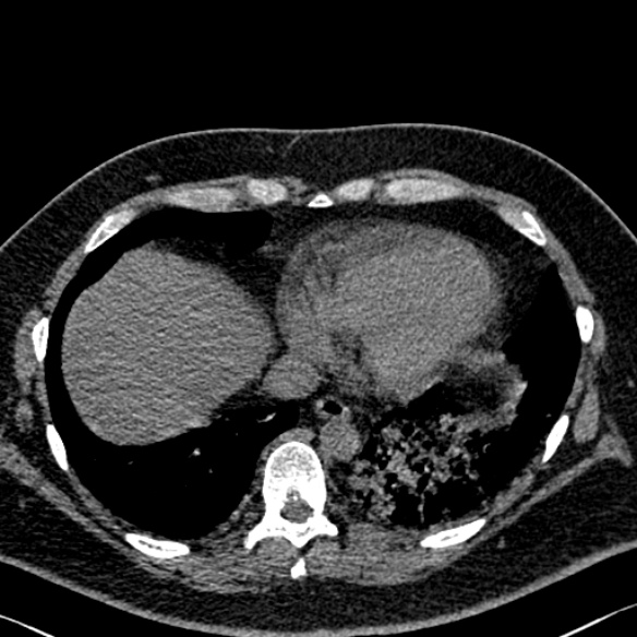 Adenoid cystic carcinoma of the trachea (Radiopaedia 49042-54137 Axial non-contrast 265).jpg