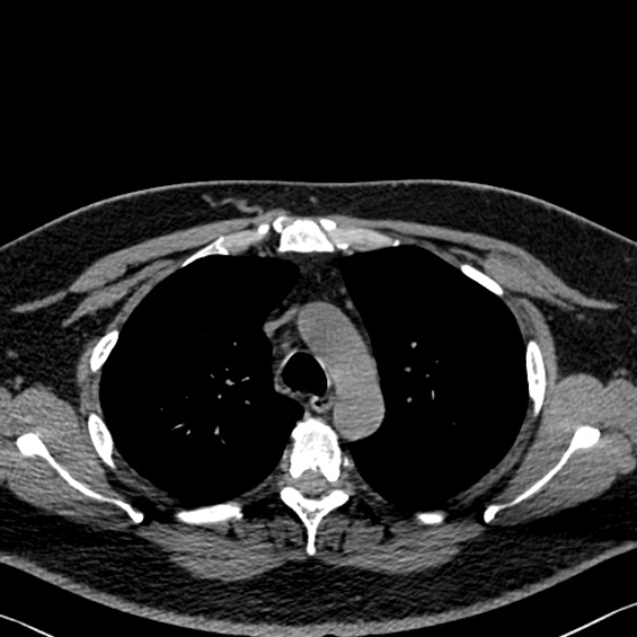 File:Adenoid cystic carcinoma of the trachea (Radiopaedia 49042-54137 Axial non-contrast 99).jpg