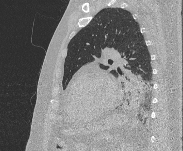 Adenoid cystic carcinoma of the trachea (Radiopaedia 49042-54137 Sagittal lung window 311).jpg
