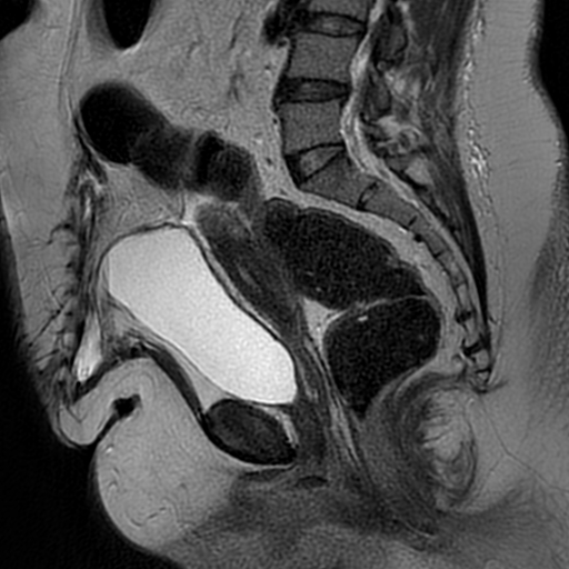 File:Adenomyosis within a didelphys uterus (Radiopaedia 70175-80215 Sagittal T2 18).jpg