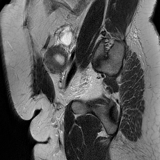 File:Adenomyosis within a didelphys uterus (Radiopaedia 70175-80215 Sagittal T2 31).jpg