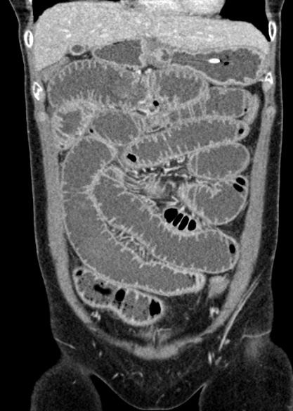 Adhesional small bowel obstruction (Radiopaedia 48397-53305 Coronal C+ portal venous phase 100).jpg