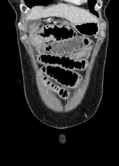 Adhesional small bowel obstruction (Radiopaedia 48397-53305 Coronal C+ portal venous phase 58).jpg