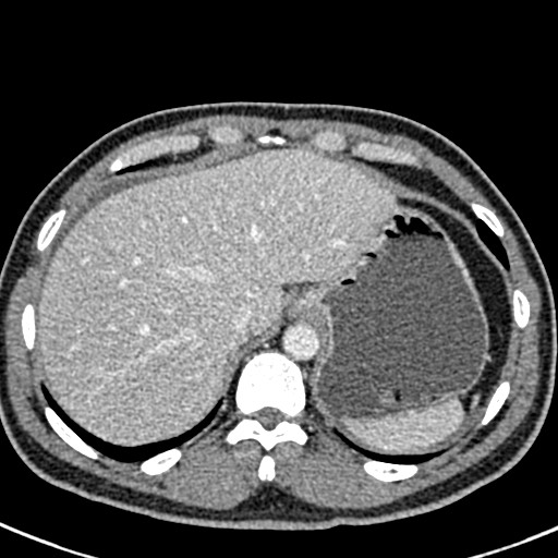 File:Adhesional small bowel obstruction (Radiopaedia 58900-66131 Axial C+ portal venous phase 8).jpg