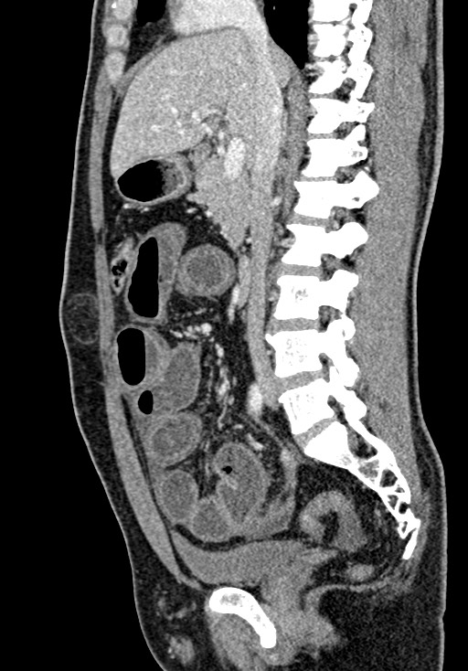 Adhesional small bowel obstruction (Radiopaedia 58900-66131 Sagittal C+ portal venous phase 111).jpg