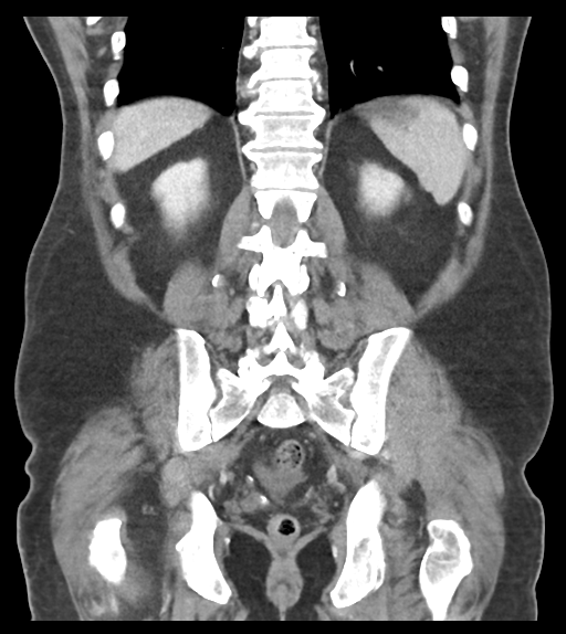 File:Adhesions within abdominal wall hernia (Radiopaedia 58283-65394 Coronal C+ portal venous phase 53).png