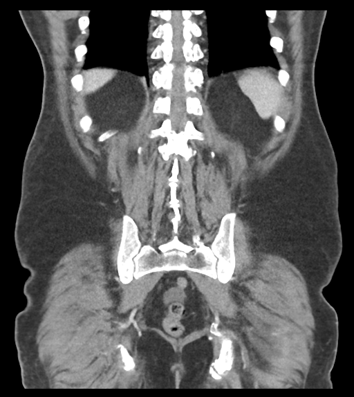 File:Adhesions within abdominal wall hernia (Radiopaedia 58283-65394 Coronal C+ portal venous phase 56).png