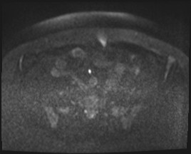 Adnexal multilocular cyst (O-RADS US 3- O-RADS MRI 3) (Radiopaedia 87426-103754 Axial DWI 62).jpg