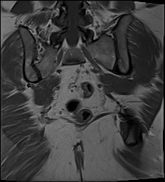 File:Adnexal multilocular cyst (O-RADS US 3- O-RADS MRI 3) (Radiopaedia 87426-103754 Coronal 26).jpg