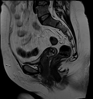File:Adnexal multilocular cyst (O-RADS US 3- O-RADS MRI 3) (Radiopaedia 87426-103754 Sagittal T2 12).jpg