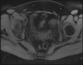 File:Adnexal multilocular cyst (O-RADS US 3. O-RADS MRI 3) (Radiopaedia 87426-103754 Axial 188).jpeg