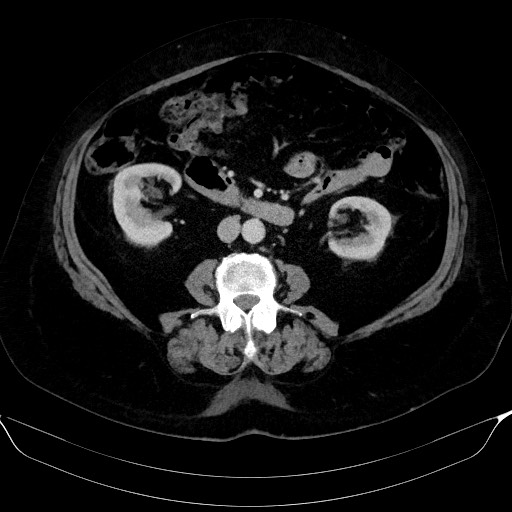 File:Adrenal cortical carcinoma (Radiopaedia 64017-72769 Axial C+ portal venous phase 35).jpg