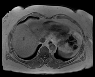 File:Adrenal cortical carcinoma (Radiopaedia 64017-72770 Axial T1 in-phase 3).jpg