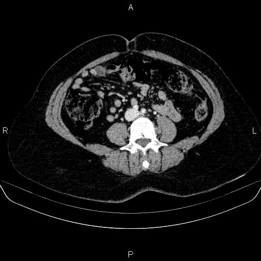 Adrenal cortical carcinoma (Radiopaedia 84882-100379 Axial C+ portal venous phase 54).jpg