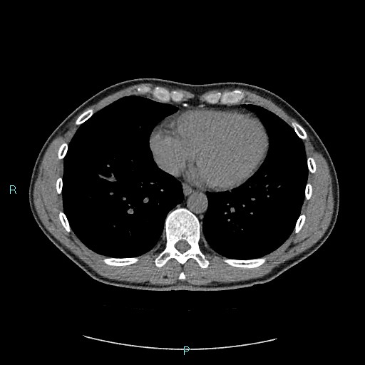 Adrenal cystic lymphangioma (Radiopaedia 83161-97534 Axial non-contrast 4).jpg