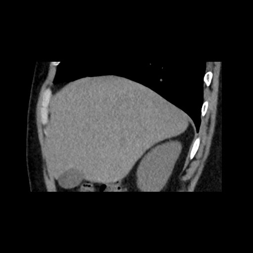 Adrenal gland trauma (Radiopaedia 81351-95079 Sagittal non-contrast 22).jpg