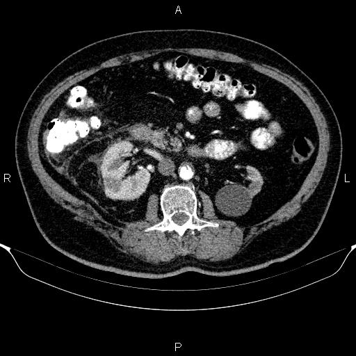 Adrenal hemorrhage (Radiopaedia 62622-70916 Axial C+ arterial phase 179).jpg