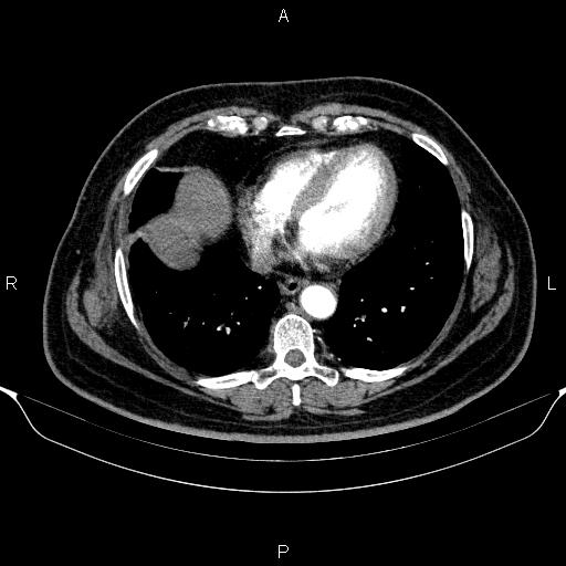 Adrenal hemorrhage (Radiopaedia 62622-70916 Axial C+ arterial phase 6).jpg