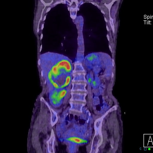 File:Adrenal metastasis from small cell lung cancer (Radiopaedia 19133-19109 Coronal 19).jpg