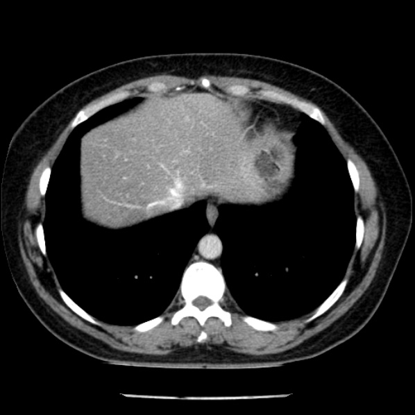 Adrenal myelolipoma (Radiopaedia 43401-46759 Axial C+ portal venous phase 8).jpg