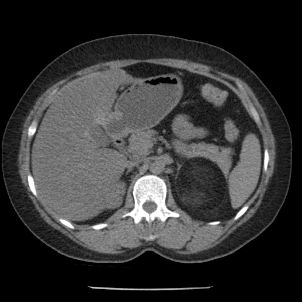 Adrenal myelolipoma (Radiopaedia 43401-46759 Axial non-contrast 28).jpg